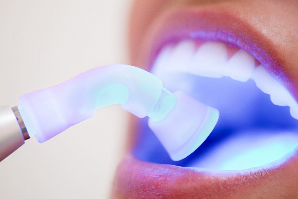  Dental bonding maintenance being performed at Vellore Corners Dentistry