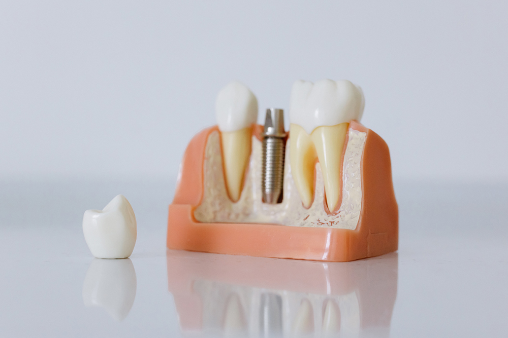 Dental implants consultation and treatment at Vellore Corners Dentistry